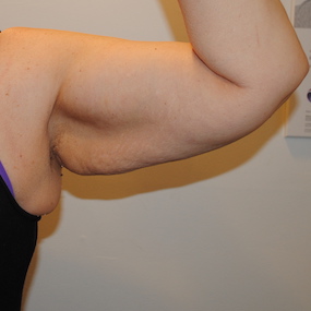 Arm Lift Before & After Patient #2596