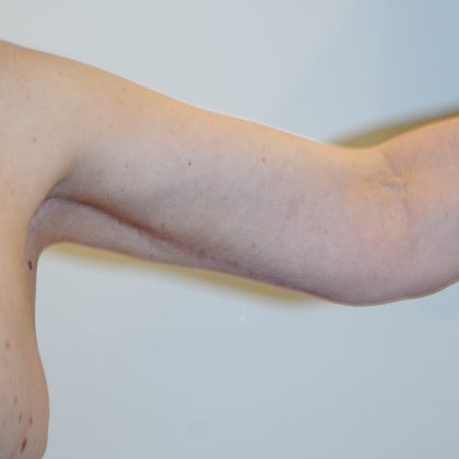 Arm Lift Before & After Patient #2596