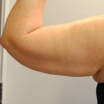 Arm Lift Before & After Patient #2596