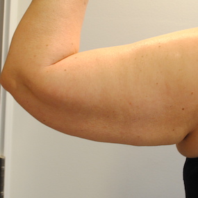 Arm Lift Before & After Patient #2596