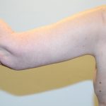 Arm Lift Before & After Patient #2596