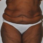 Body Lift Before & After Patient #2422