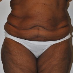 Body Lift Before & After Patient #2422