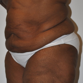 Body Lift Before & After Patient #2422