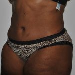 Body Lift Before & After Patient #2422