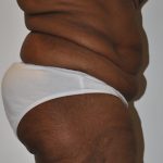 Body Lift Before & After Patient #2422