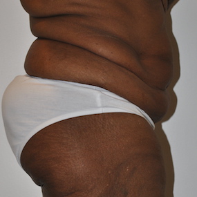 Body Lift Before & After Patient #2422