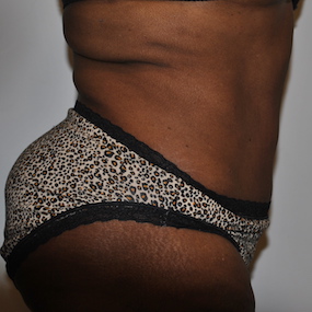 Body Lift Before & After Patient #2422