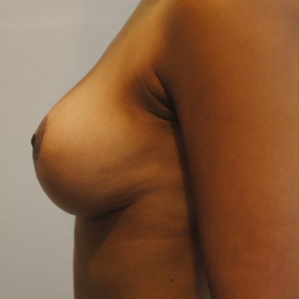 Breast Lift Before & After Patient #2635