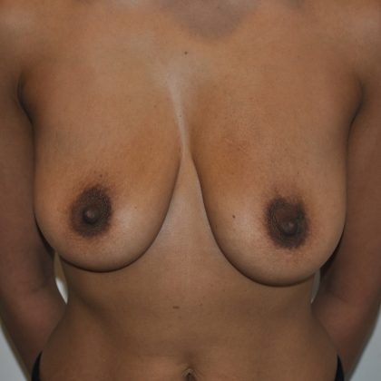 Breast Lift Before & After Patient #2635