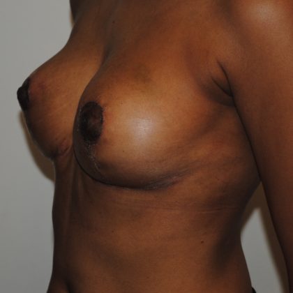 Breast Lift Before & After Patient #2635