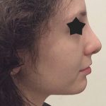 Chin Augmentation Before & After Patient #2305