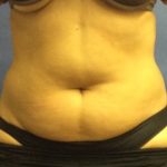 Liposuction Before & After Patient #2497