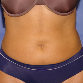 Liposuction Before & After Patient #2497