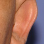 Otoplasty Before & After Patient #2294
