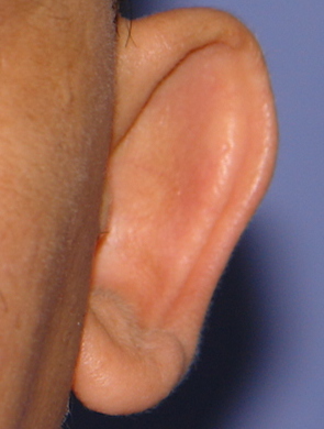 Otoplasty Before & After Patient #2294