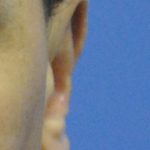 Otoplasty Before & After Patient #2294