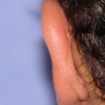 Otoplasty Before & After Patient #2294
