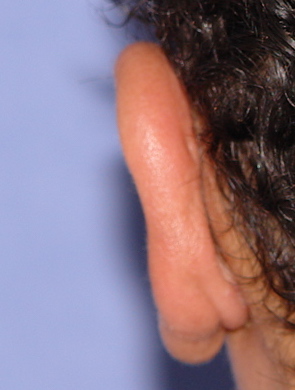 Otoplasty Before & After Patient #2294