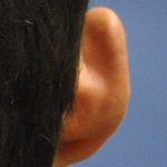 Otoplasty Before & After Patient #2294