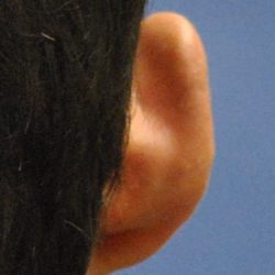 Otoplasty Before & After Patient #2294