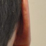 Otoplasty Before & After Patient #2294