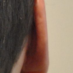 Otoplasty Before & After Patient #2294
