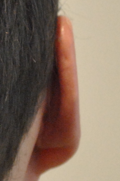 Otoplasty Before & After Patient #2294
