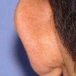 Otoplasty Before & After Patient #2294
