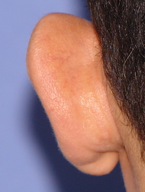 Otoplasty Before & After Patient #2294