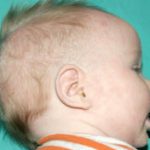 Pediatric Treatments Before & After Patient #2787