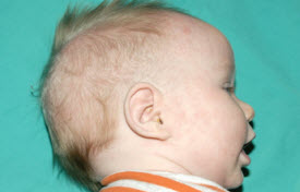 Pediatric Treatments Before & After Patient #2787