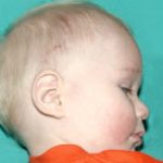 Pediatric Treatments Before & After Patient #2787