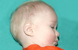 Pediatric Treatments Before & After Patient #2787