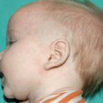 Pediatric Treatments Before & After Patient #2787