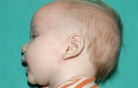 Pediatric Treatments Before & After Patient #2787