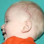 Pediatric Treatments Before & After Patient #2787