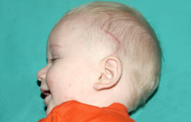 Pediatric Treatments Before & After Patient #2787