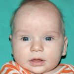 Pediatric Treatments Before & After Patient #2787
