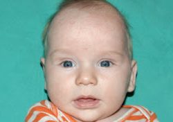Pediatric Treatments Before & After Patient #2787