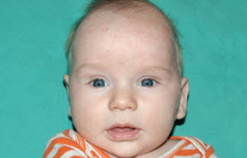 Pediatric Treatments Before & After Patient #2787