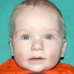 Pediatric Treatments Before & After Patient #2787