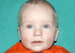 Pediatric Treatments Before & After Patient #2787