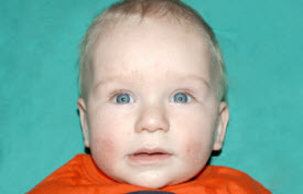 Pediatric Treatments Before & After Patient #2787