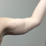 After Weight Loss Before & After Patient #2426
