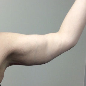 After Weight Loss Before & After Patient #2426