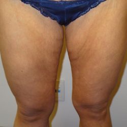 Thigh Lift Before & After Patient #2446
