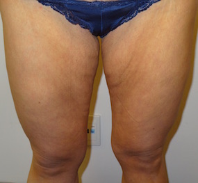 Thigh Lift Before & After Patient #2446