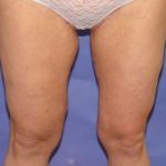 Thigh Lift Before & After Patient #2446