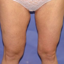 Thigh Lift Before & After Patient #2446